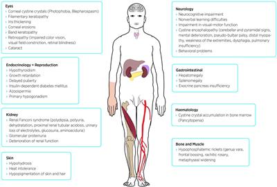 Nephropathic Cystinosis: Symptoms, Treatment, and Perspectives of a Systemic Disease